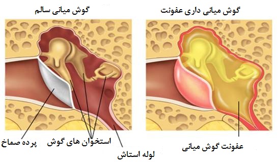 عفونت گوش مياني در اطفال